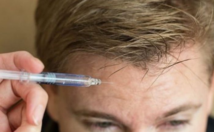 Verdades detrás del uso de botox. Fuente: Instagram / @willeke_kamphof